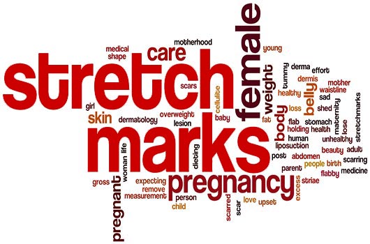 Fine-Lines-How-to-Make-Your-Stretch-Marks-Go-Away-MainPhoto