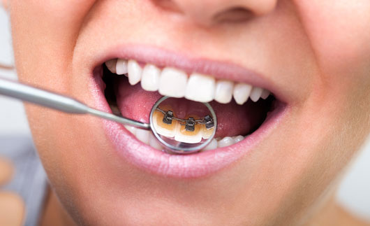 5-maneras-de-arreglar-tus-dientes-chuecos-Photo4