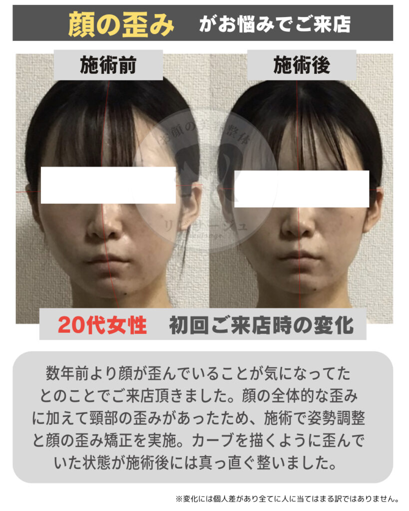 顔の歪み原因と治し方を徹底解明！左右差の悪習慣から病気のサインまで
