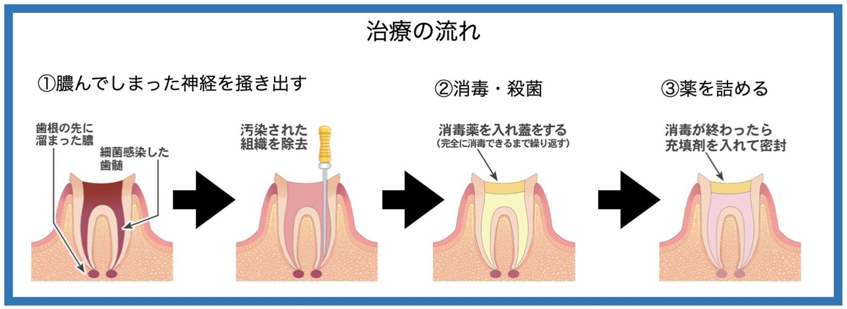 走ると歯が痛いのはなぜ？虫歯と副鼻腔炎の決定打と正しい対処法