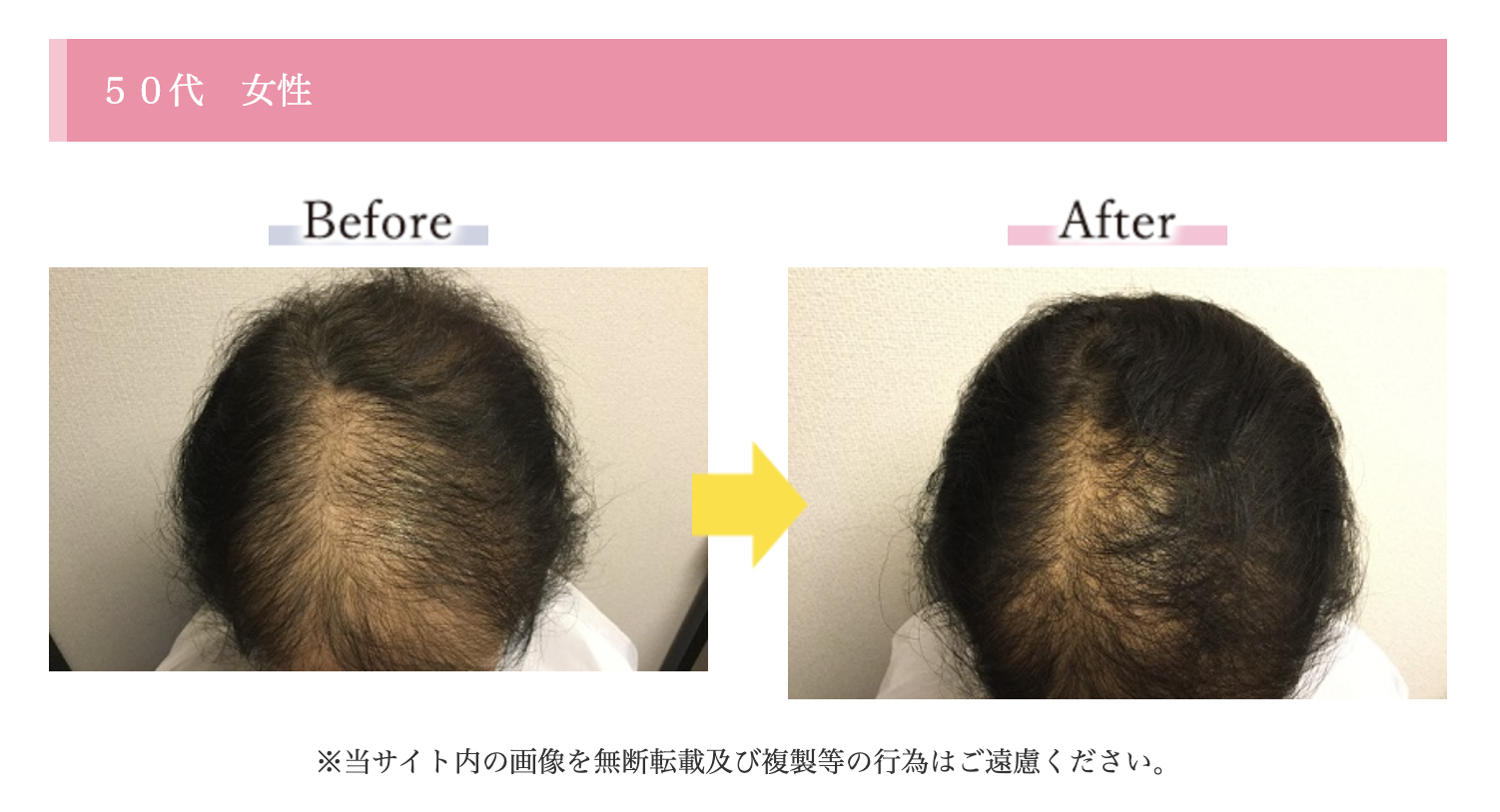 頭皮のかゆみと抜け毛急増の真相｜薄毛リスクを防ぐ2026年最新改善策