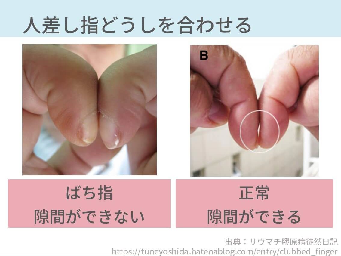 ばち状爪は肺がんの予兆？爪の異変で見分ける重大疾患と受診目安
