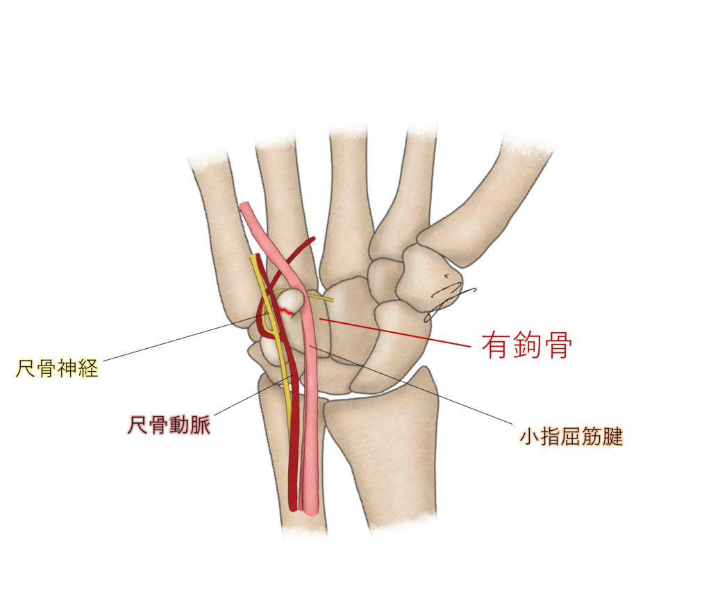 有鉤骨骨折の真相と復帰期間｜手術費用から初期症状の罠まで徹底解説