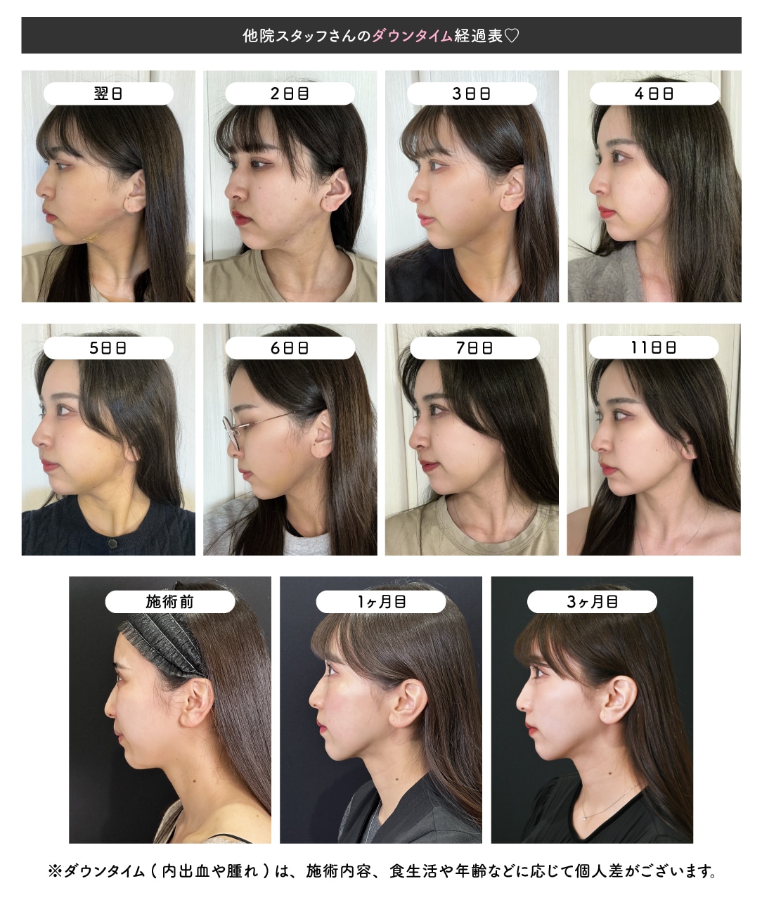 顔の脂肪吸引ダウンタイム完全検証！腫れのピークと仕事復帰の真実