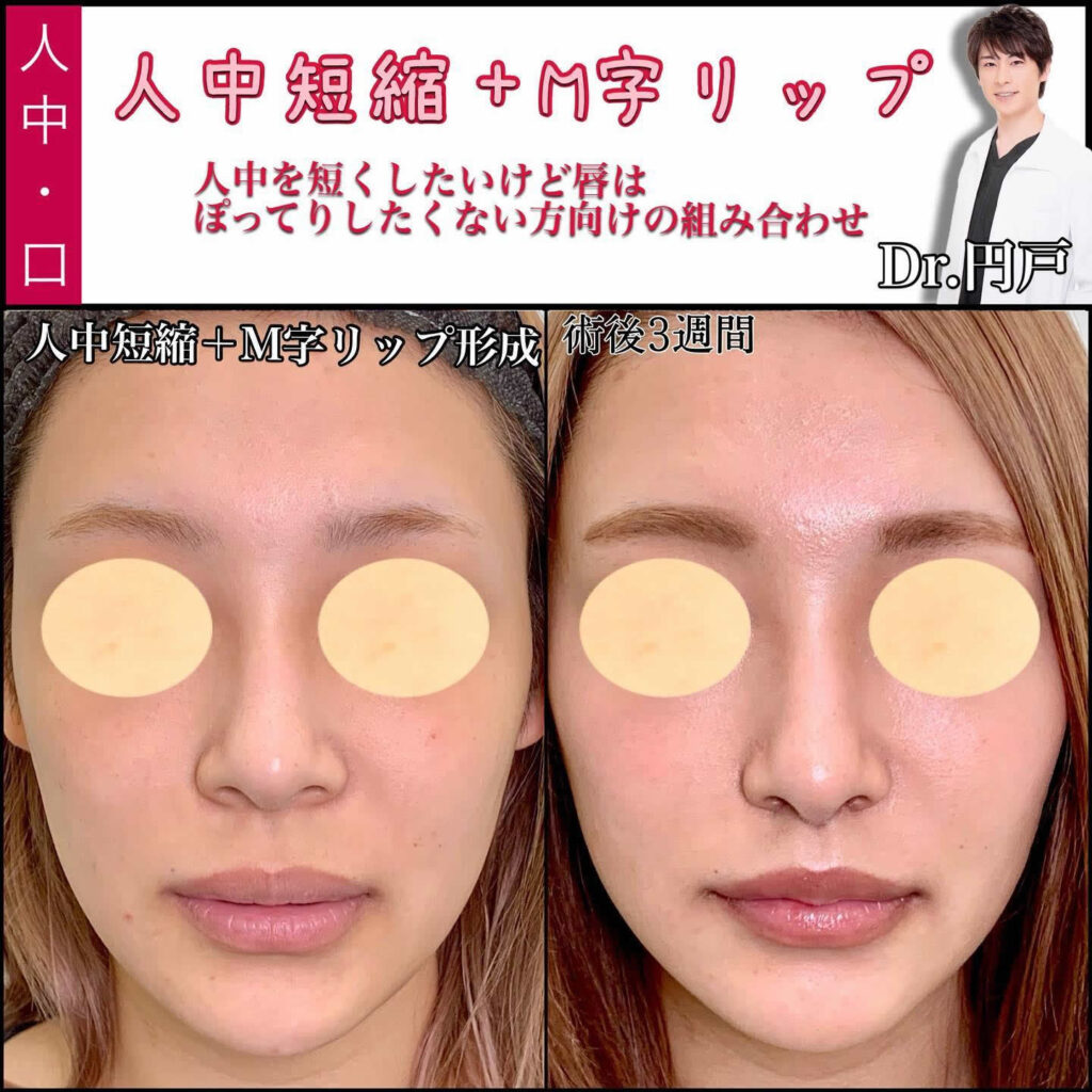 アヒル口は生まれつき？遺伝・骨格・自力で作れるかの真相2026
