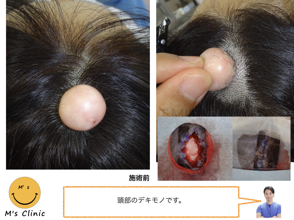頭皮のできもの・しこりの正体は？症例画像の特徴と原因・治療法を解説