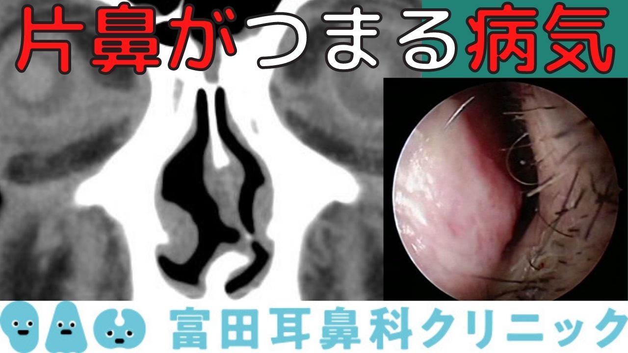 片方の鼻だけ詰まる原因は病気？生理現象との違いと即効解消法