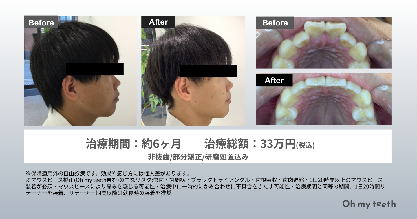 歯列矯正で顔はどう変わる？輪郭・Eライン劇的変化写真と失敗の真相
