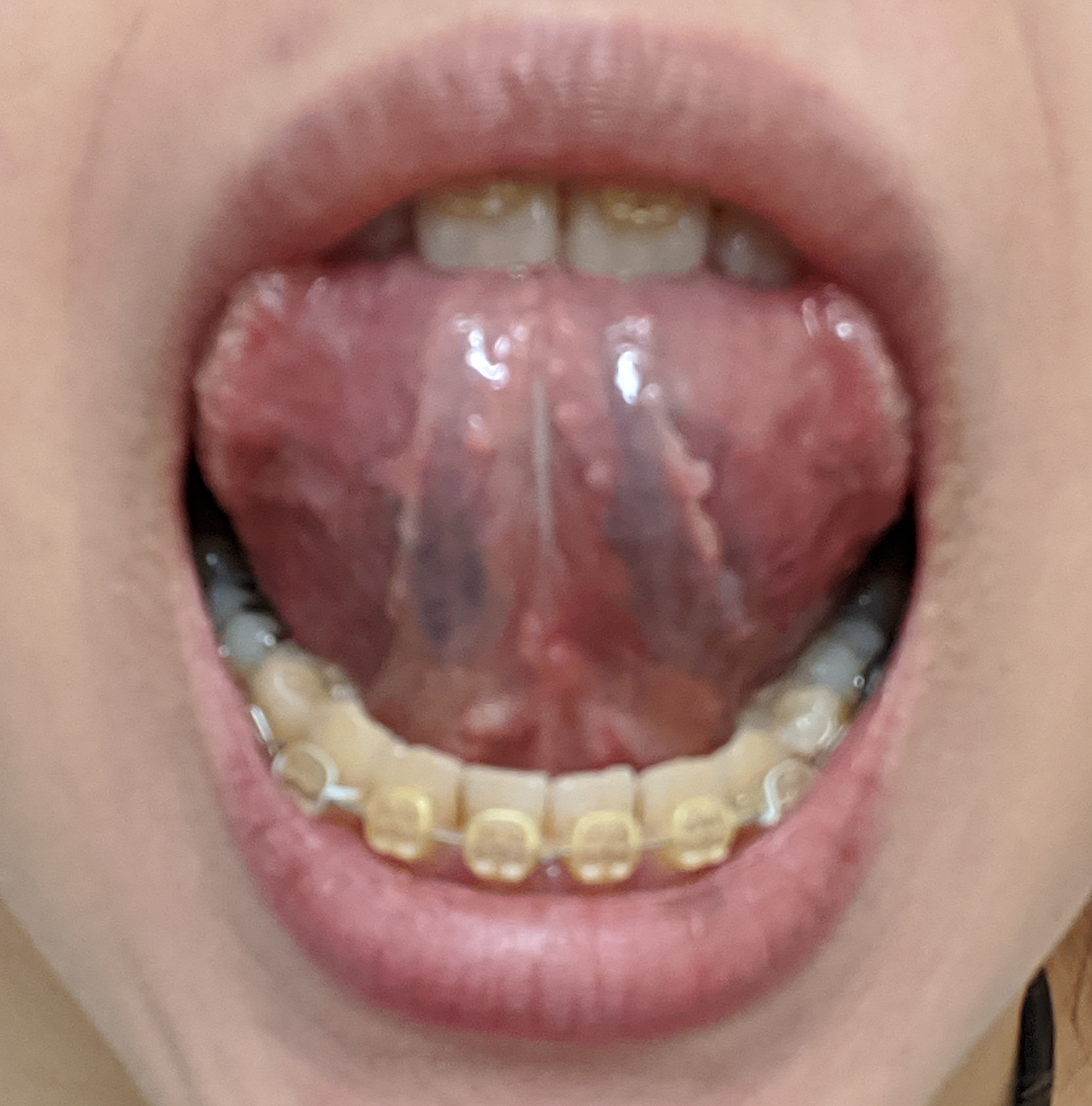 舌の裏のぶつぶつは病気か正常か？痛くない理由と舌癌の見分け方【2026年最新】