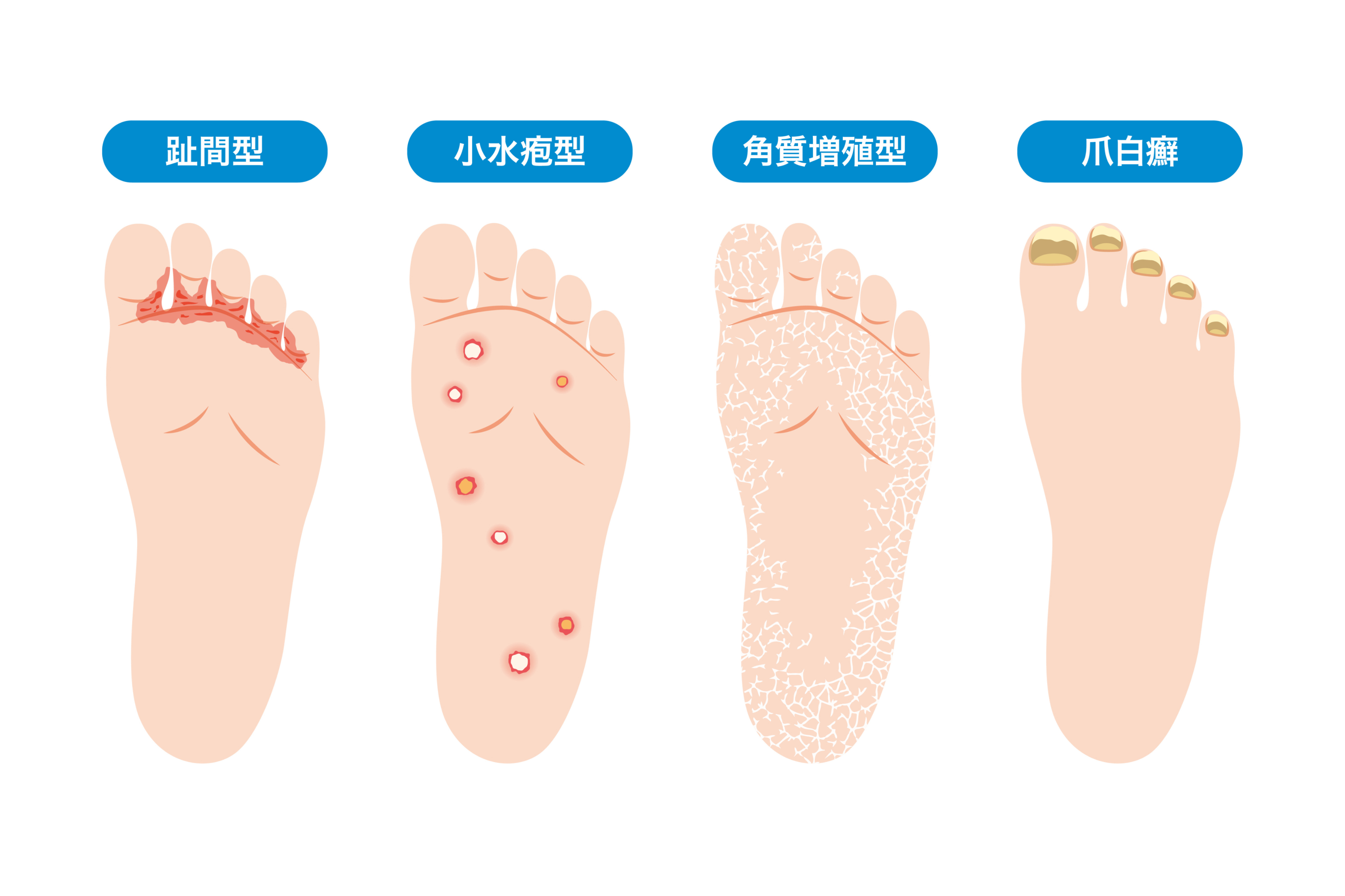 白癬（水虫）の正体と治し方｜感染経路から最新治療まで徹底検証