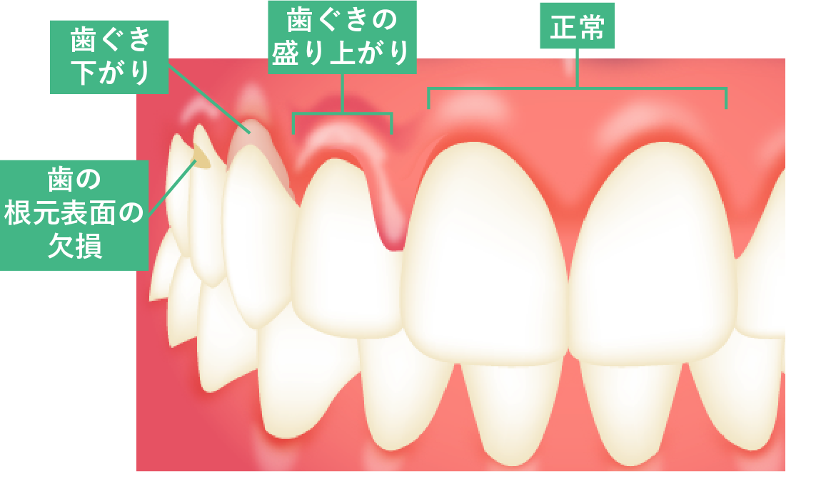 歯磨きのしすぎは逆効果？歯茎下がりや知覚過敏を招く衝撃の真実とは