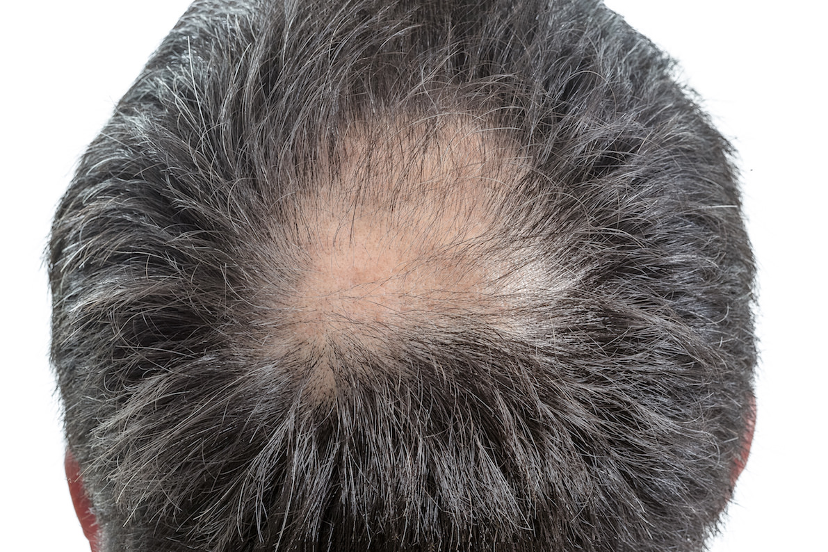 ハゲ頭・薄毛の悩みを解決！進行の真相から似合う髪型まで徹底解剖