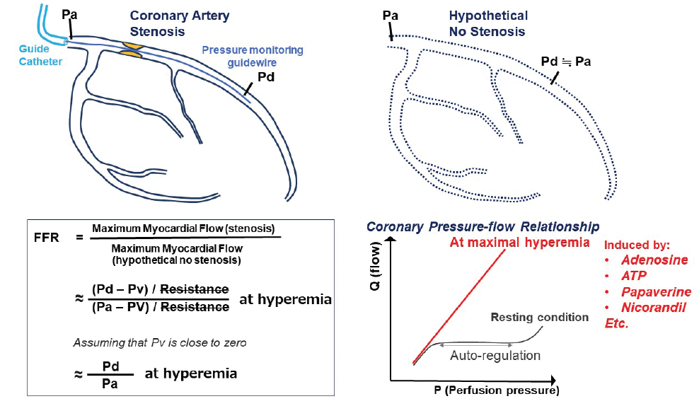 What Is Ffr in Cardiology