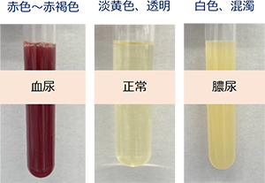 【噂】 膀胱 炎 尿 色 最新画像・動画まとめ #645