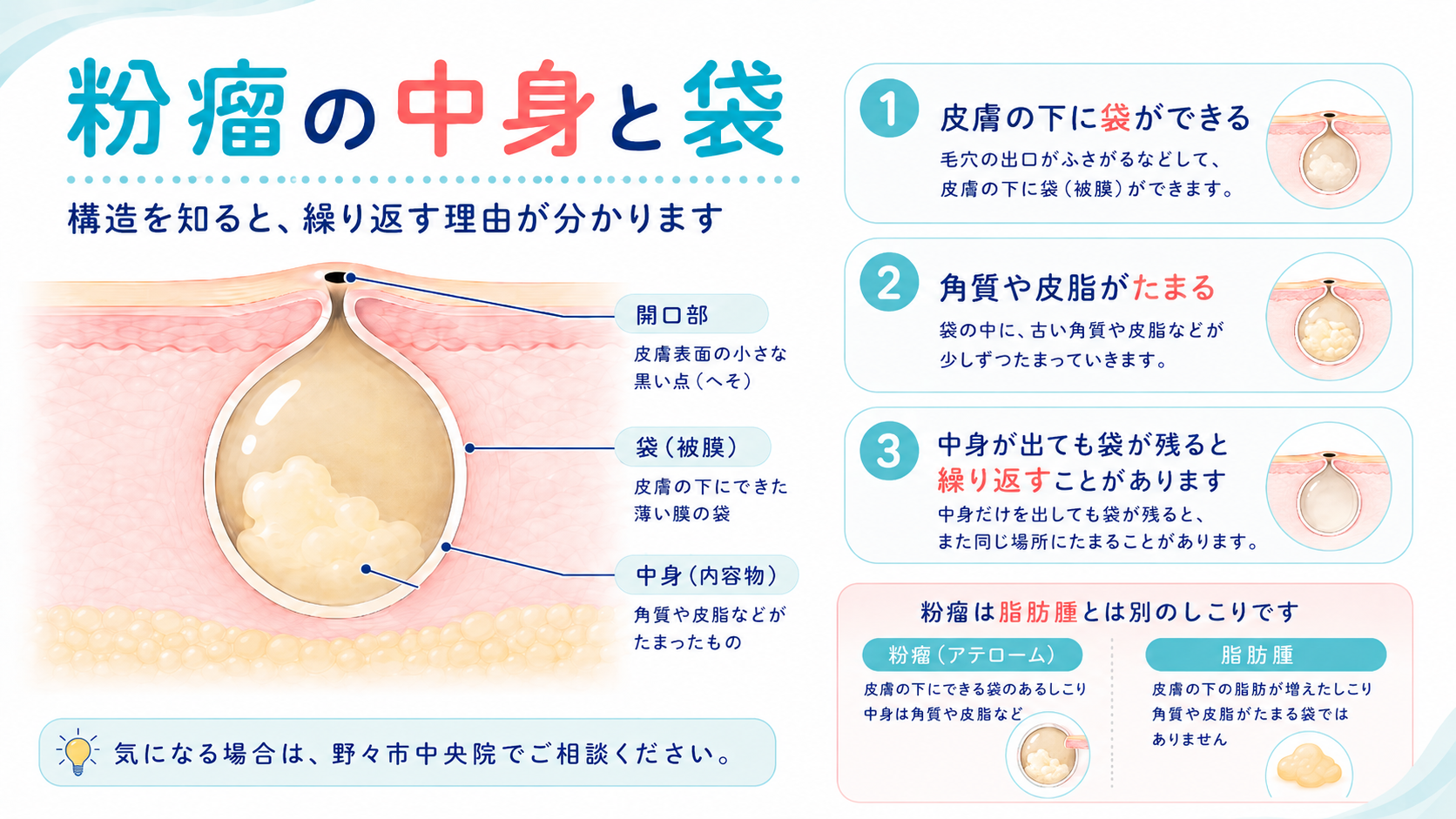 粉瘤の臭いはなぜ強烈？悪臭の正体と自分で潰す危険性・根本治療法
