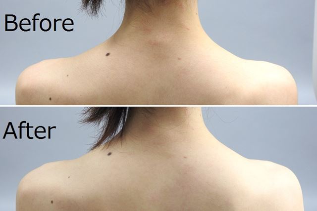背中の産毛処理で肌トラブル急増？プロが明かす美肌への最短ルート