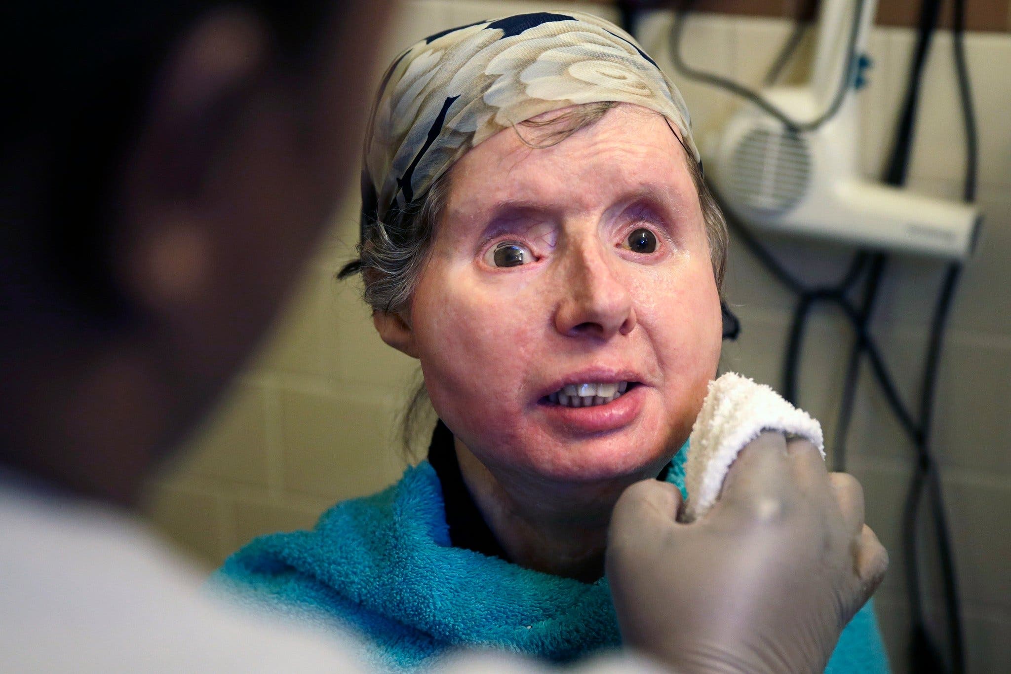 Woman That Got Attacked by a Chimpanzee