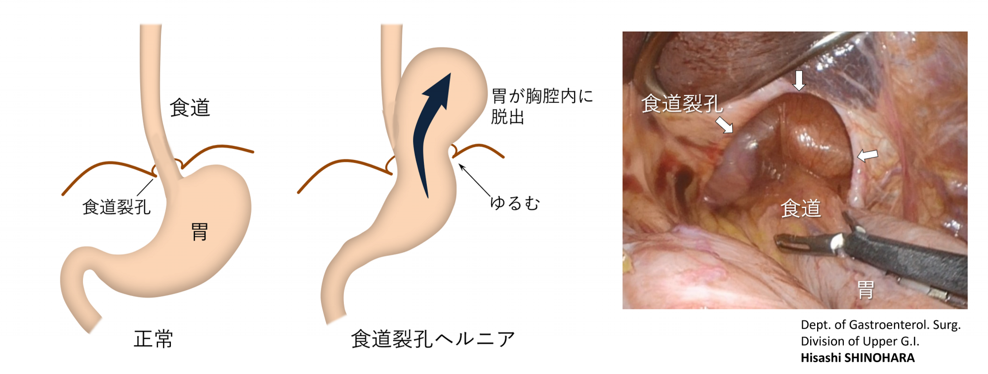 胃ヘルニアの症状と原因を徹底解説！放置の危険性と最新治療法の真実