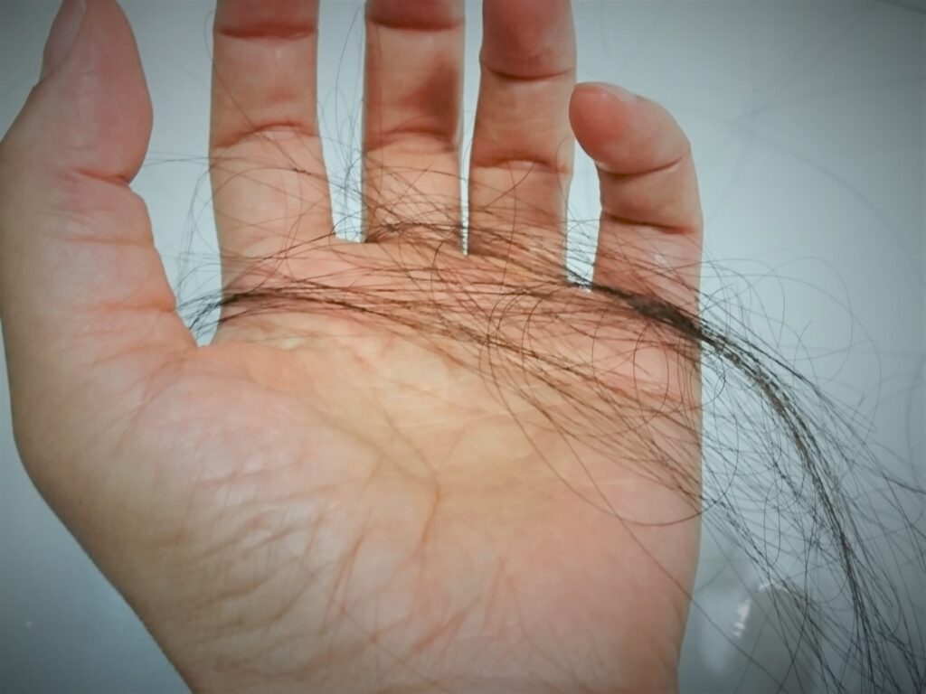 突然髪がごっそり抜ける謎｜休止期脱毛症の治る前兆と2026年最新治療