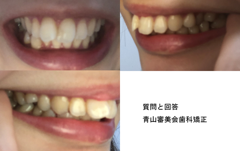 片方だけ出っ歯がかわいい理由とは？愛される秘密と最新トレンド
