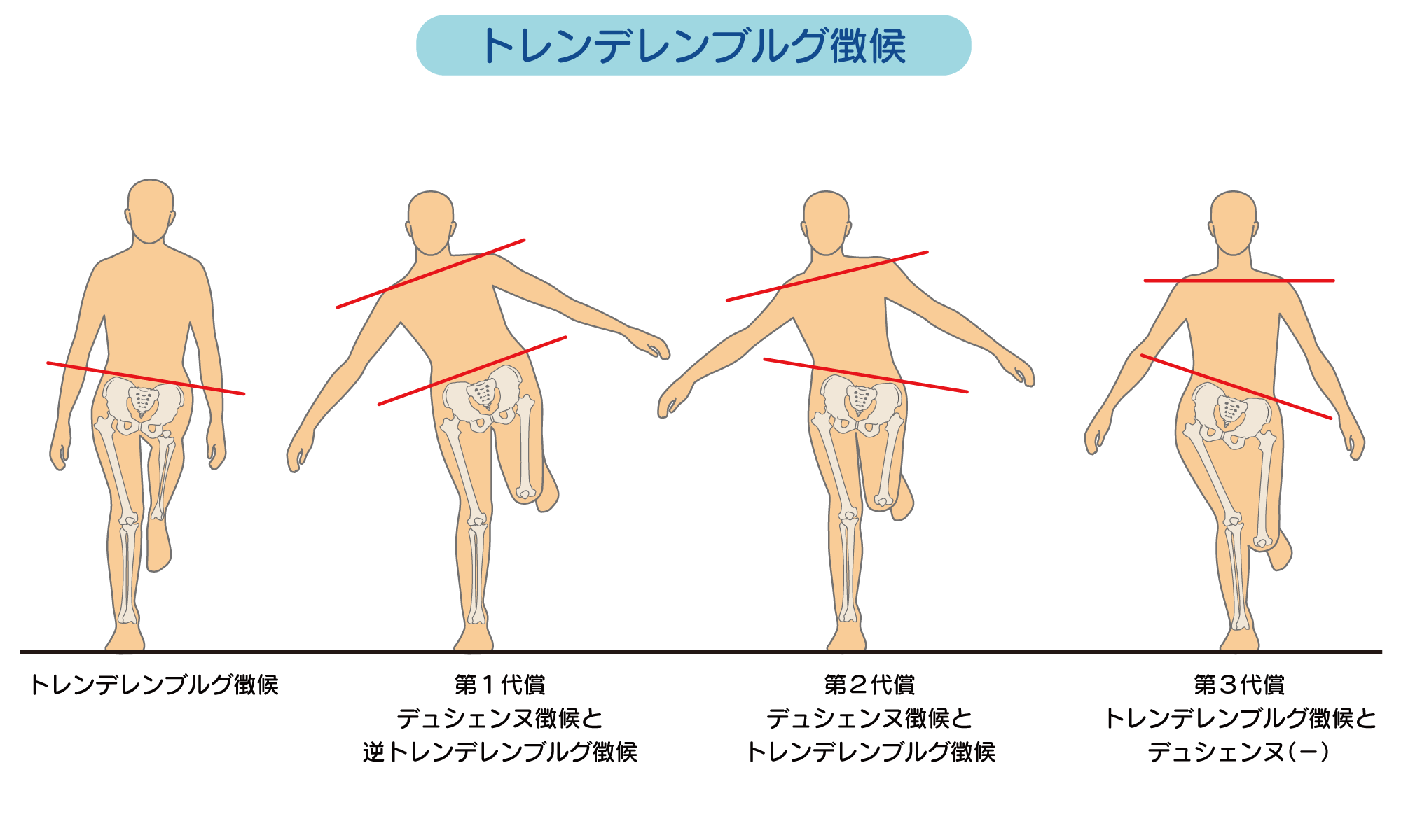 トレンデレンブルグ歩行の原因と見分け方｜2026年最新リハビリ解説