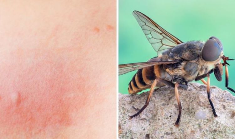 Show Me Pictures of a Horse Fly Bite Nhs
