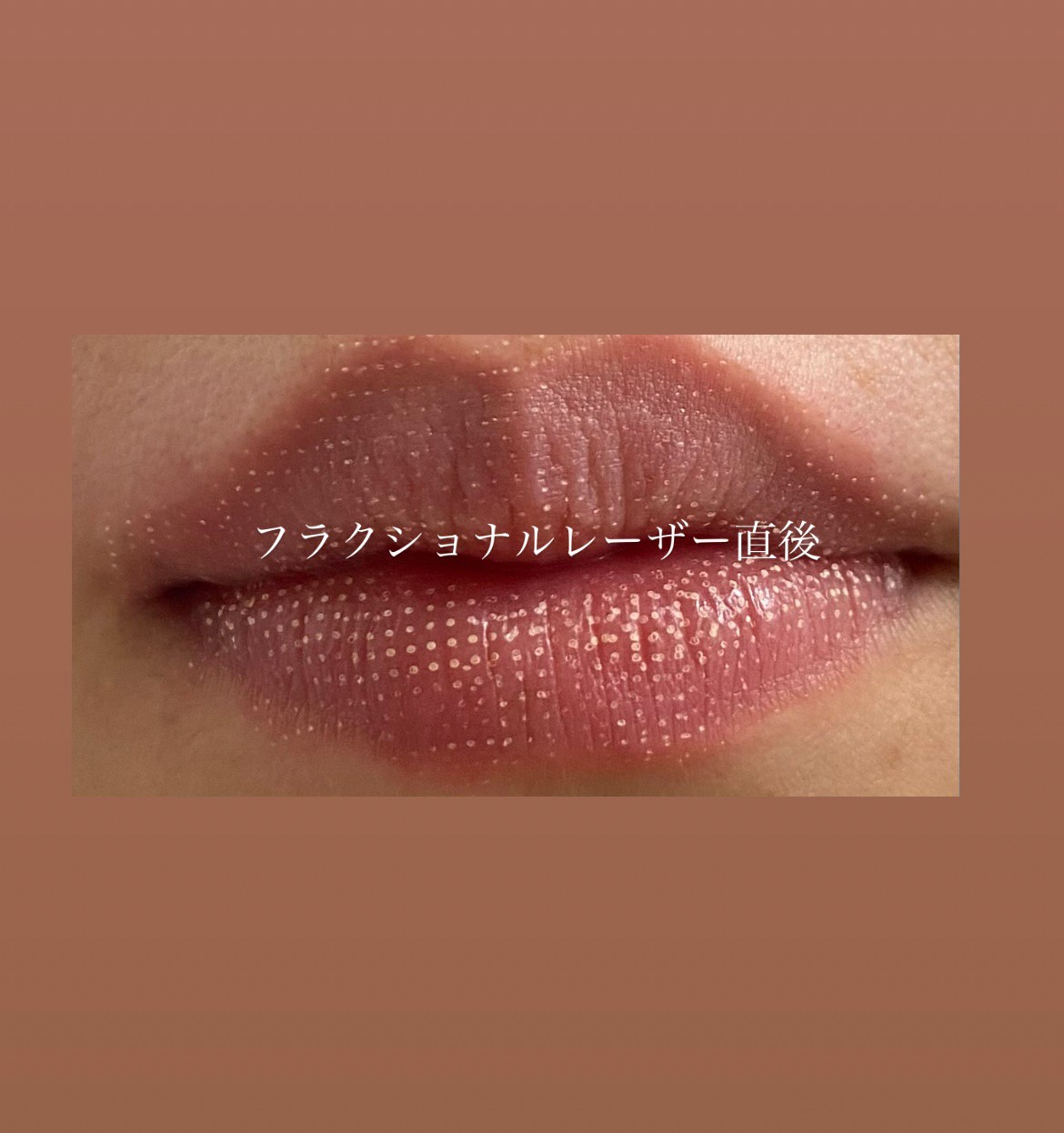 ティントで唇が色素沈着する噂は嘘？黒ずみの真相と正しい落とし方