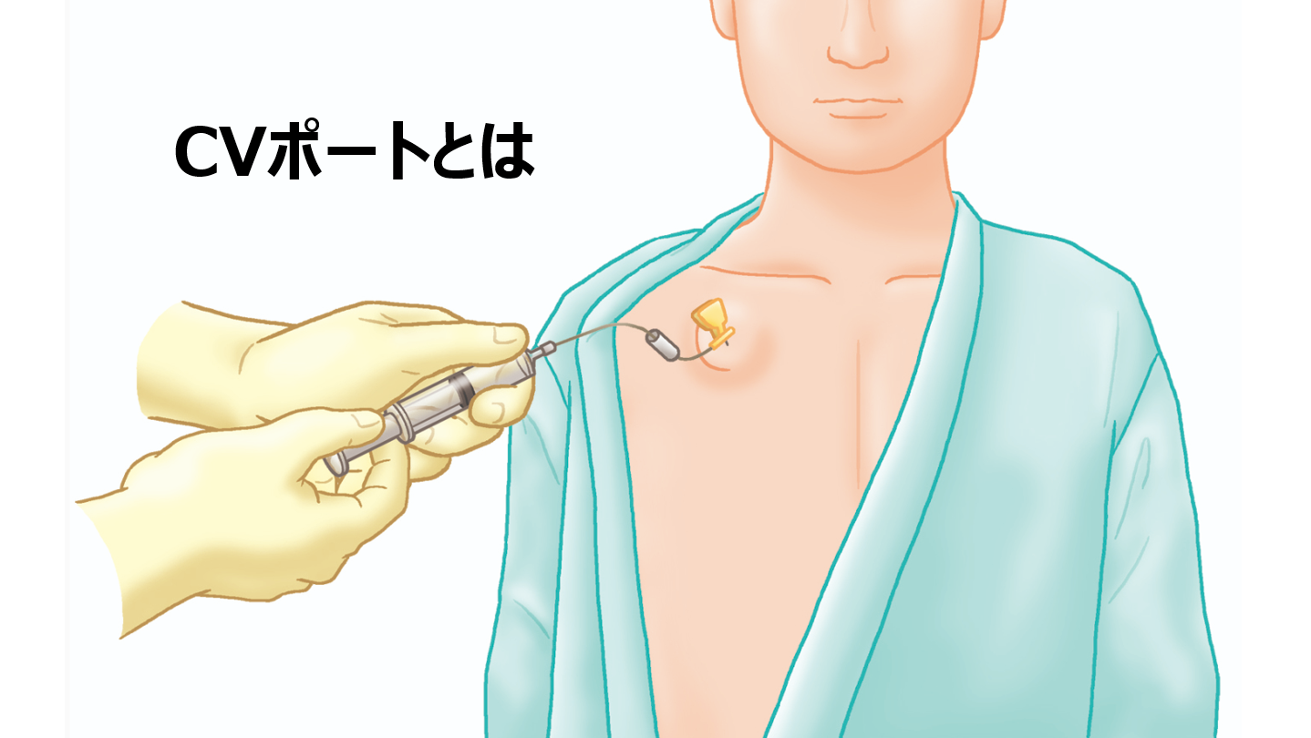 Cvポートとは？点滴治療を劇的に変える仕組みと費用・痛みの真実