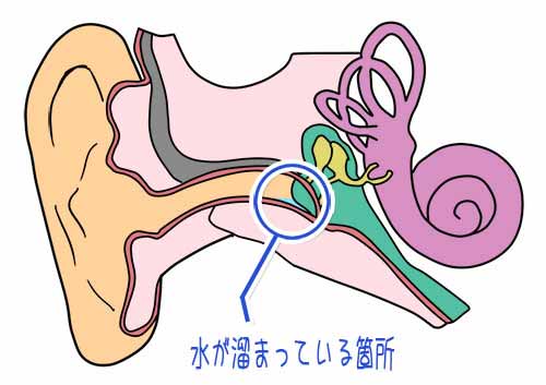 耳に水が入って取れない！綿棒Ngの理由とティッシュで抜く裏ワザ