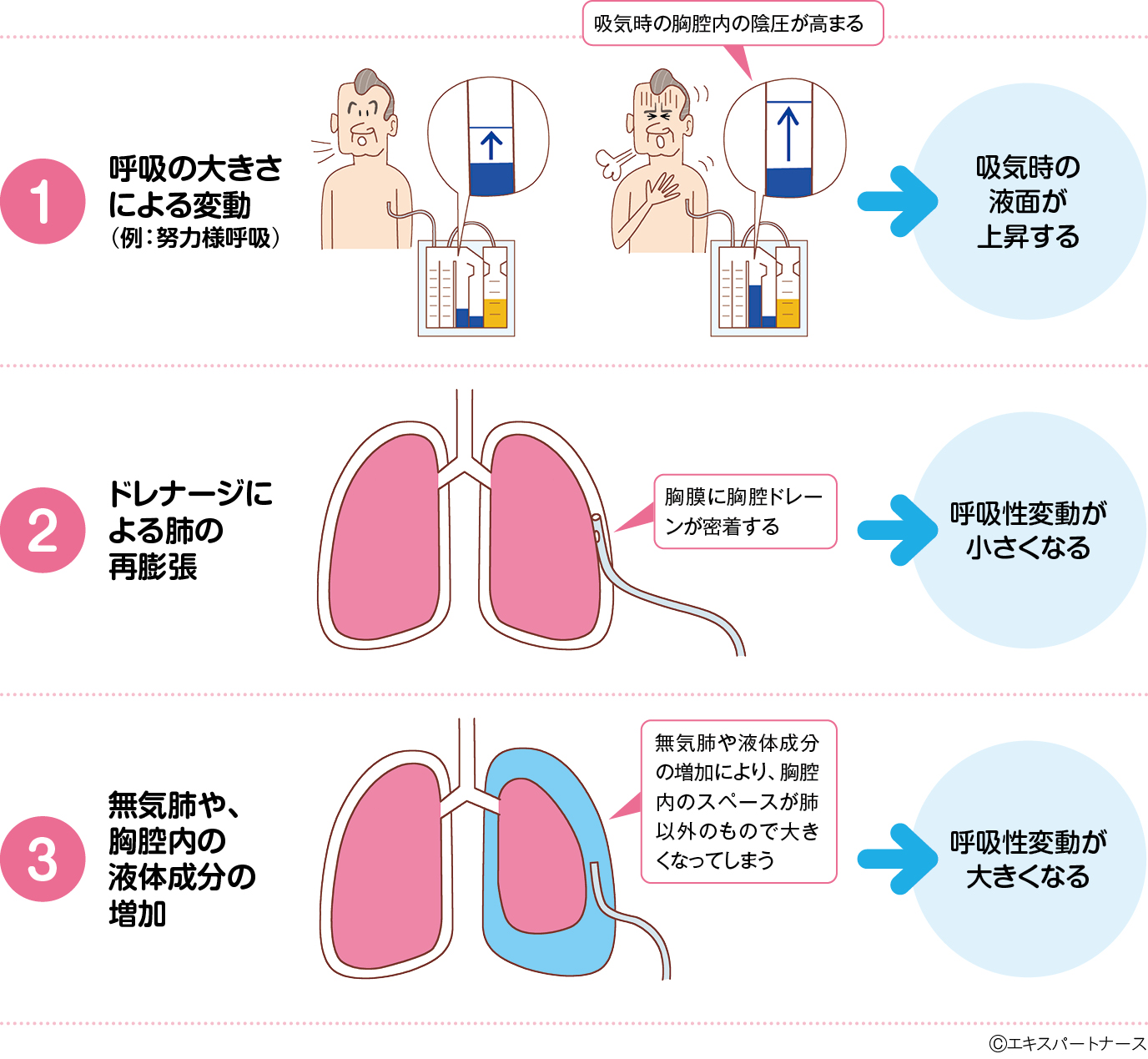 胸腔ドレーンの呼吸性変動とは？消失の理由と観察ポイント徹底解説