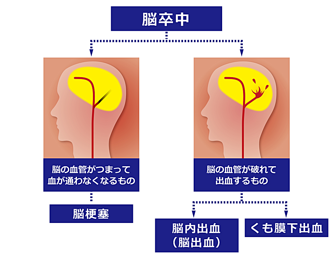 脳卒中と脳梗塞の違いを専門医が解説！命を守る初期症状と対応策