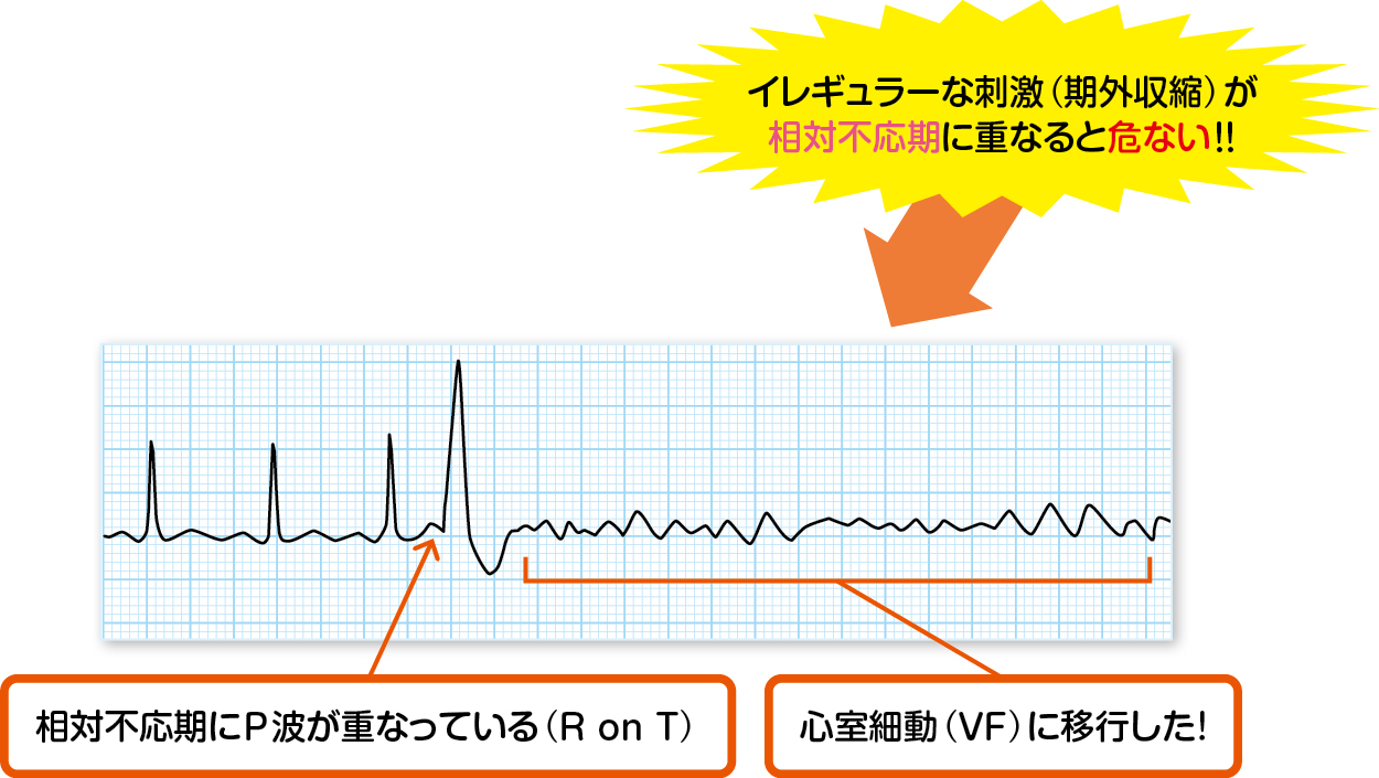 健診の「心房期外収縮」は放置禁物？脈が飛ぶ原因と危険なサイン
