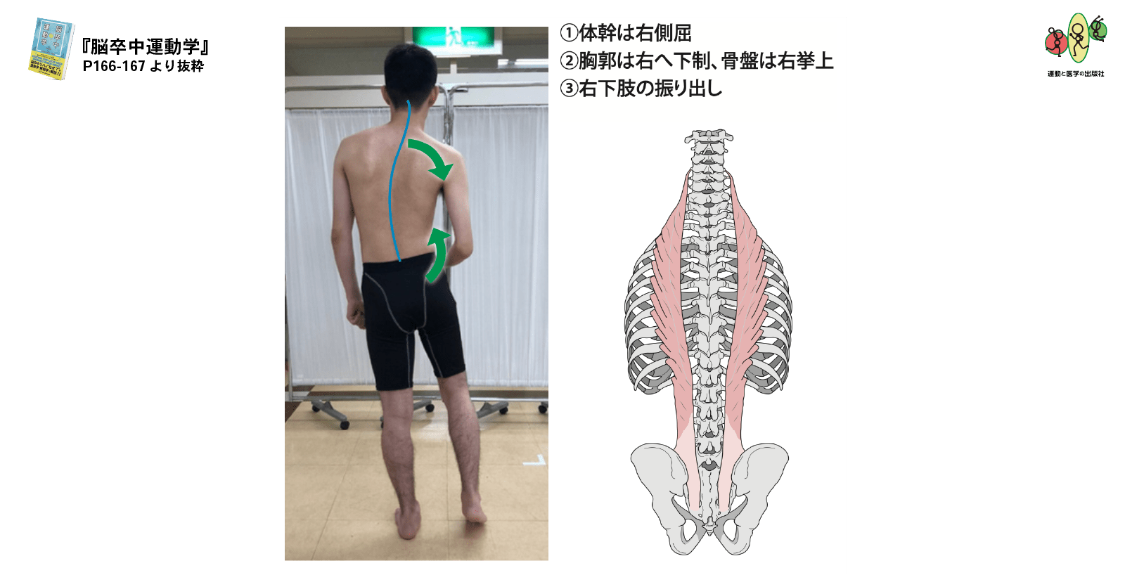 ぶん回し歩行の原因とメカニズム｜片麻痺リハビリと装具の最新改善法