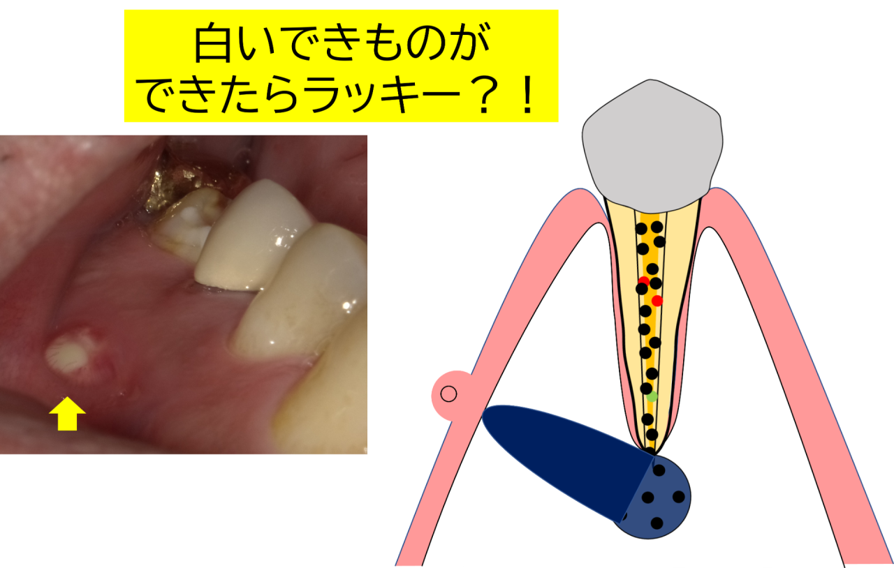 歯茎の白いできものは放置厳禁！痛くない理由と原因別の治療法を徹底解説
