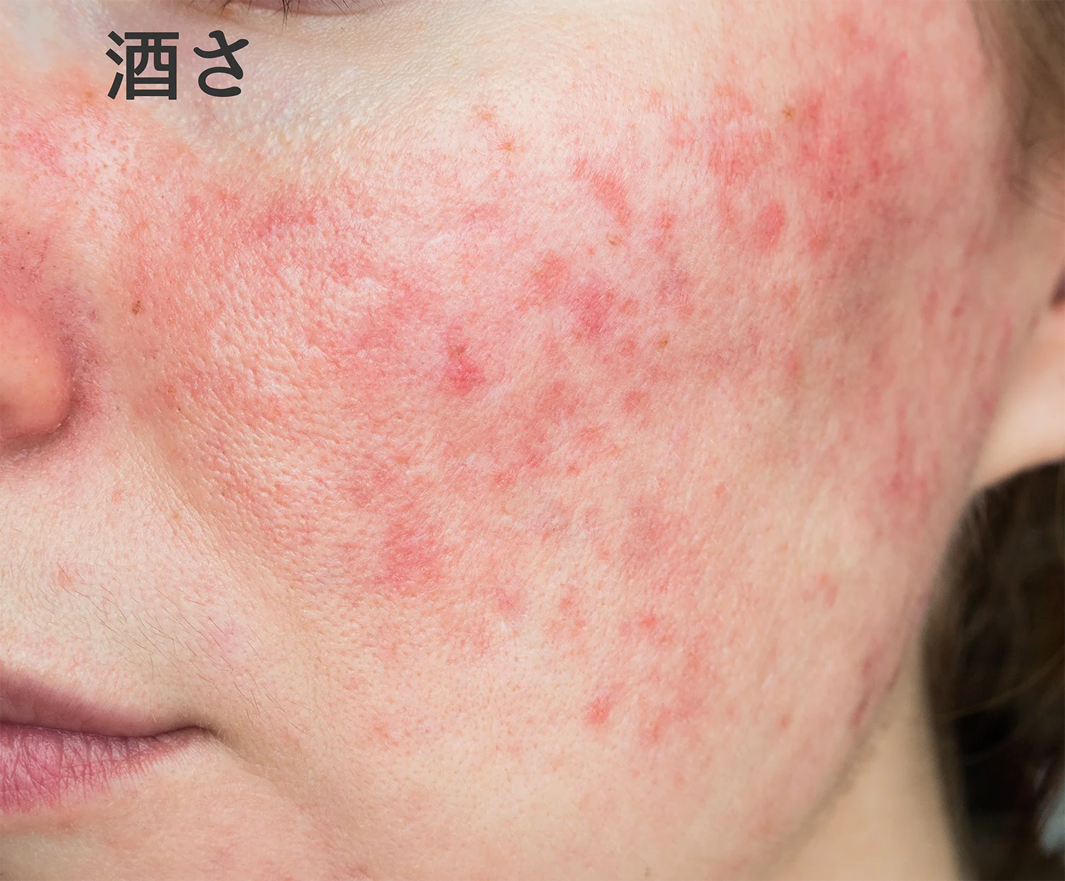 顔に湿疹が突然現れた原因とは？赤み・かゆみの正体と正しい治し方
