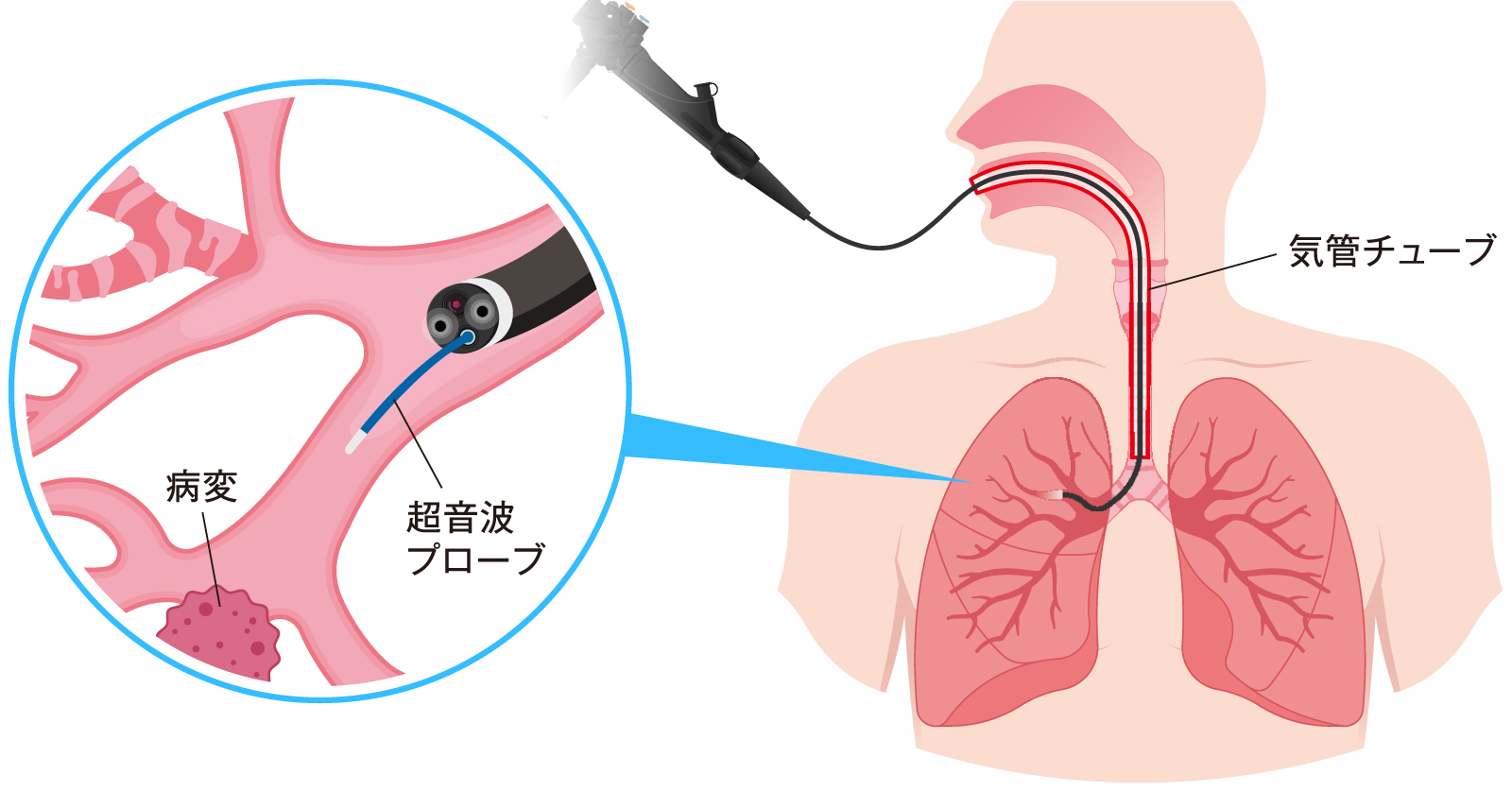 気管支鏡検査は本当に苦しい？眠っている間に終わる真相と費用を徹底解説