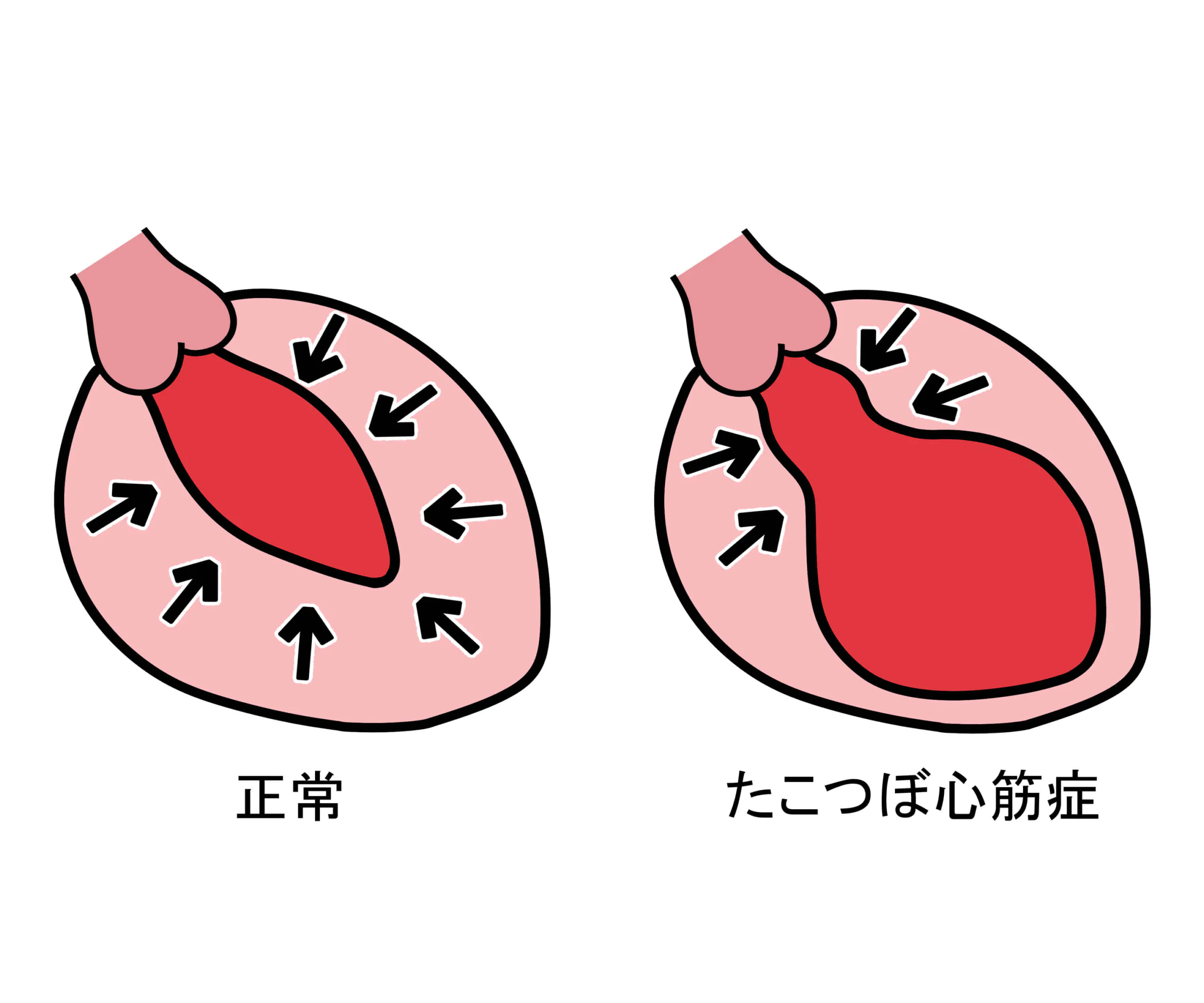 突然の激しい胸痛…たこつぼ心筋症のサインと心筋梗塞との決定的な違い