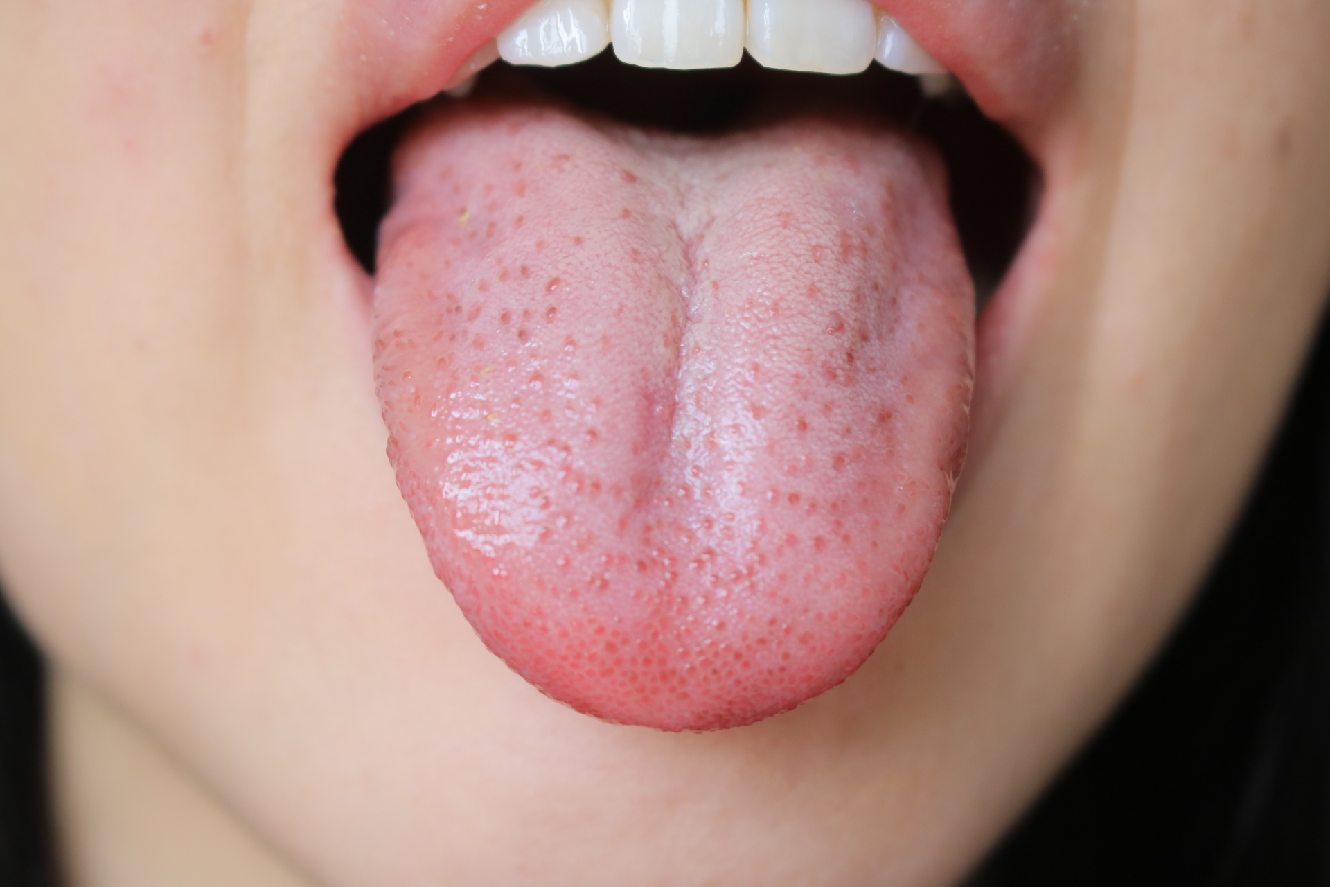 舌が白い画像の症例比較！舌苔と病気の見分け方・危険なサイン徹底解説