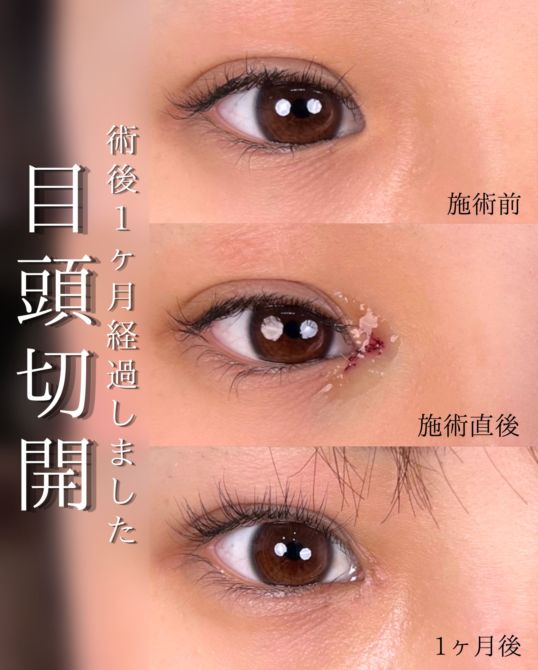 目頭切開のダウンタイム【完全版】腫れピークと仕事復帰まで徹底解説