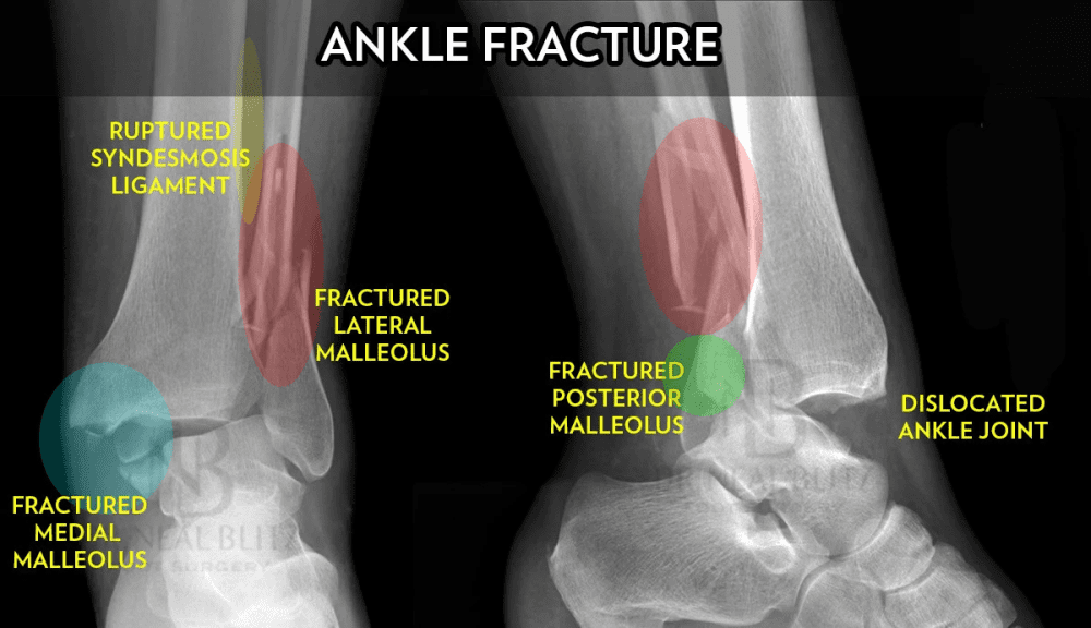 What a Fractured Ankle Looks Like