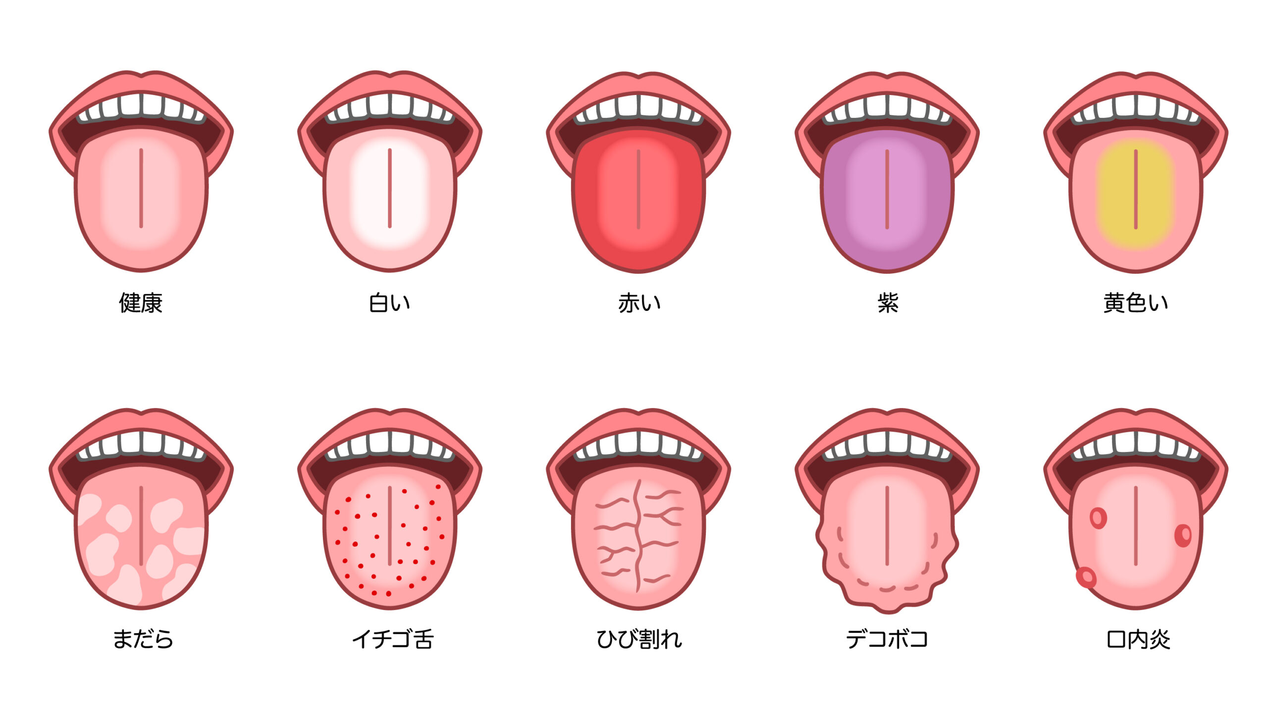 舌でわかる病気と危険なサイン総点検！色や形で見る初期症状と受診目安