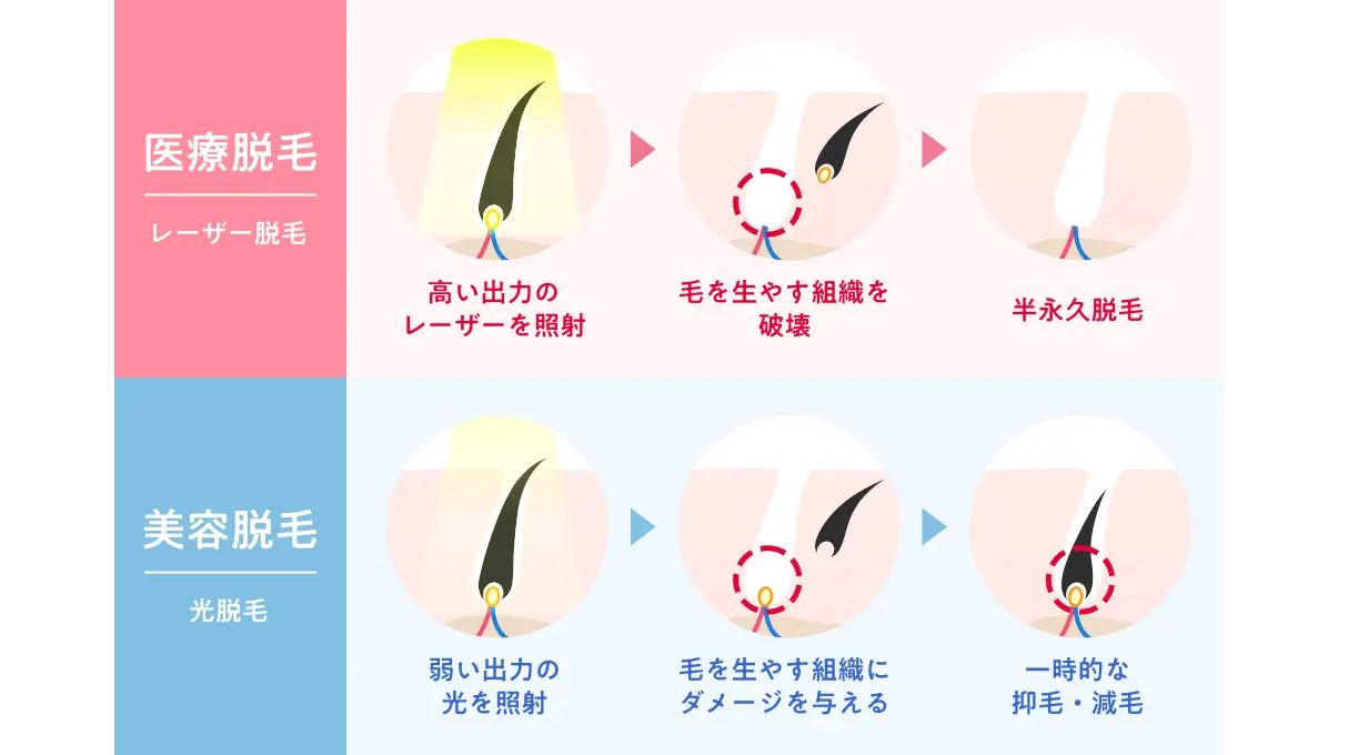 医療脱毛と美容脱毛の違いは？永久脱毛の真相と費用相場【2026最新】