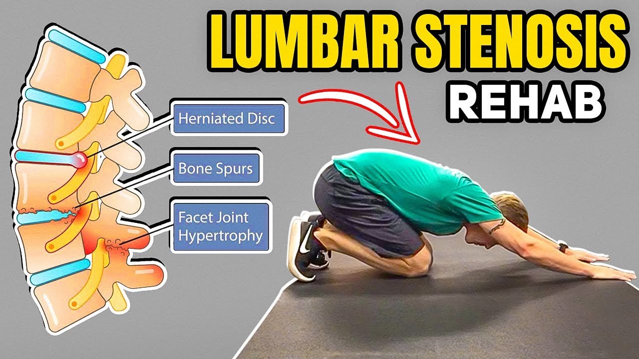 Exercises for Lumbar Spinal Canal Stenosis