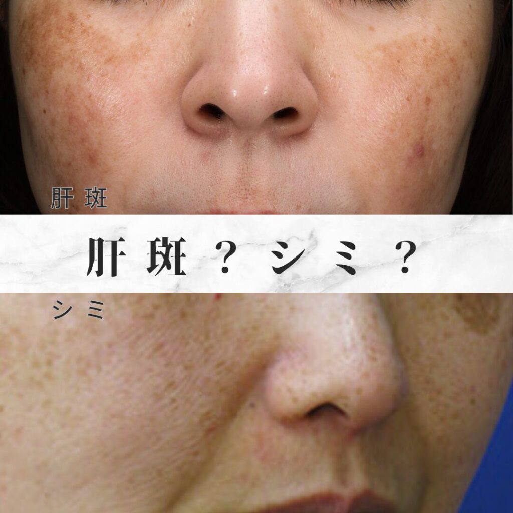 「そのシミ実は肝斑かも？」違いの見分け方と悪化防ぐ2026年最新治療