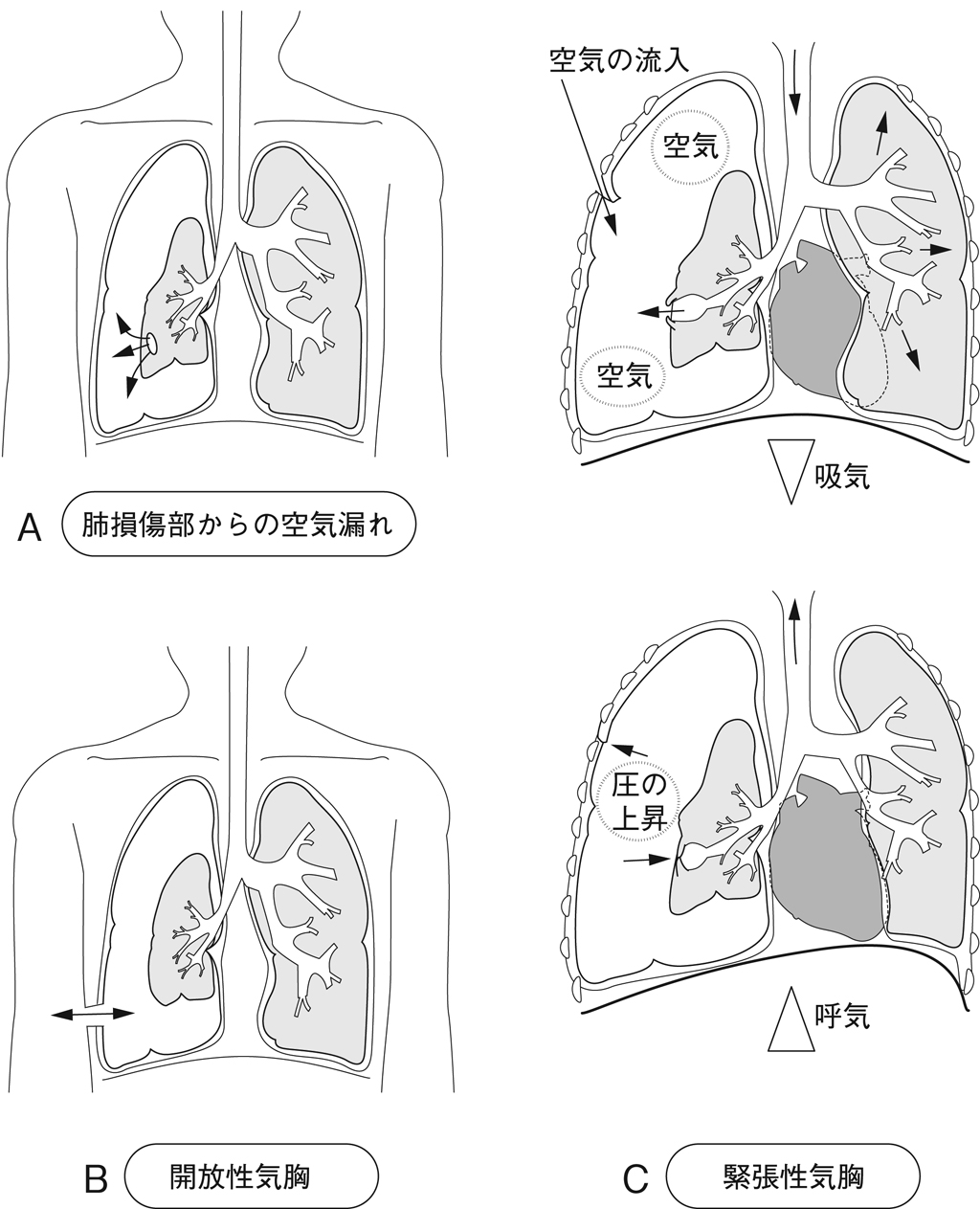 緊張性気胸とは？なぜ数分で命を奪うのか｜通常気胸との違いと初期対応