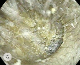 【2026最新】 耳垢 湿っ て いる 最新画像・動画まとめ #958