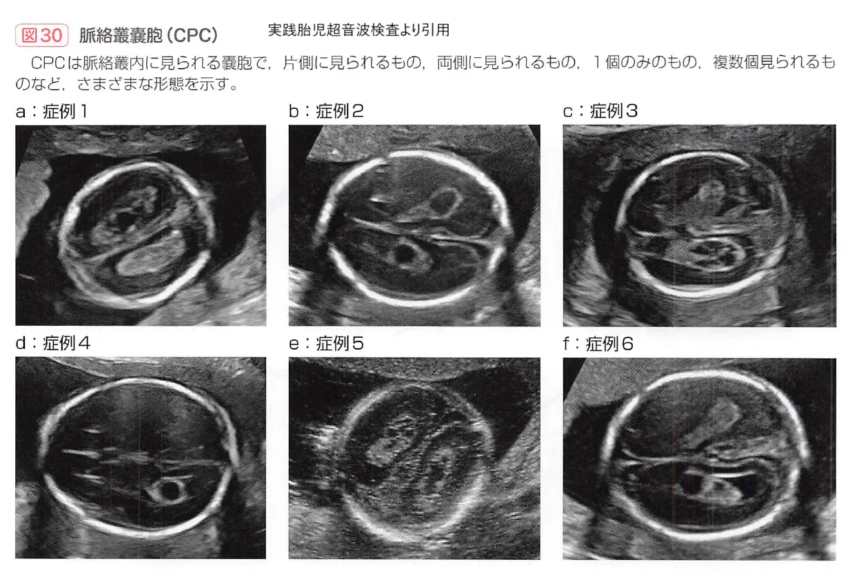 妊娠10週エコーでダウン症は判明する？首のむくみNtと鼻骨の真相