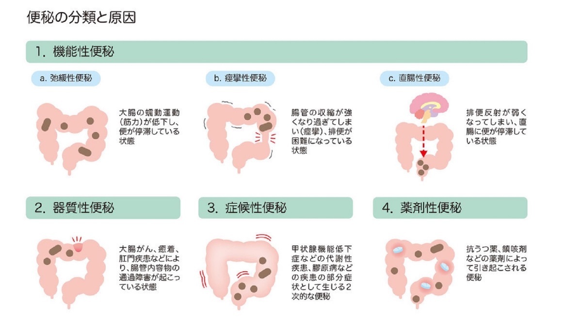 お腹の張りは弛緩性便秘が原因？腸を動かす決定的な治し方と食事術