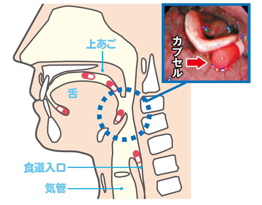 薬が喉に詰まった感じが消えない原因と危険信号｜今すぐ治すプロの対処法