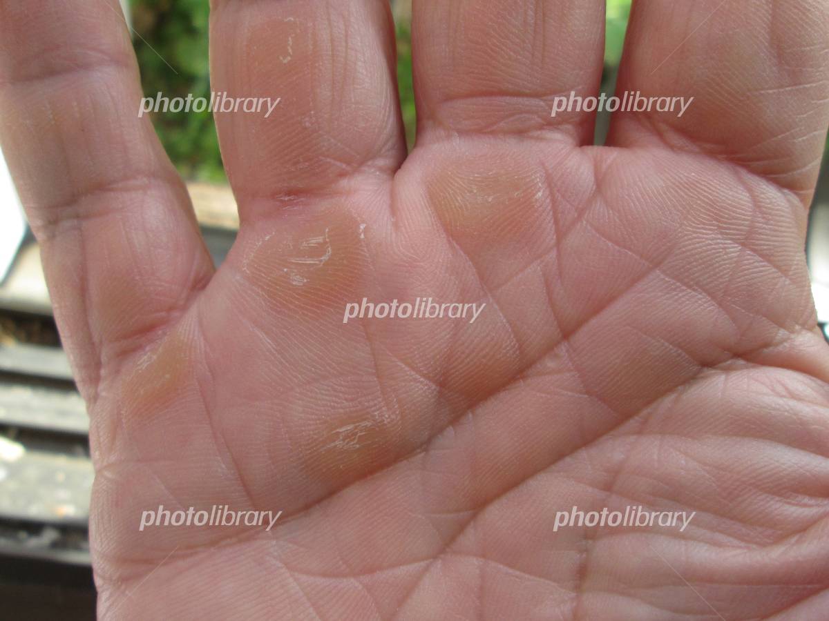 手の豆が痛い！潰すのはNg？早く治す処置法と予防策完全ガイド
